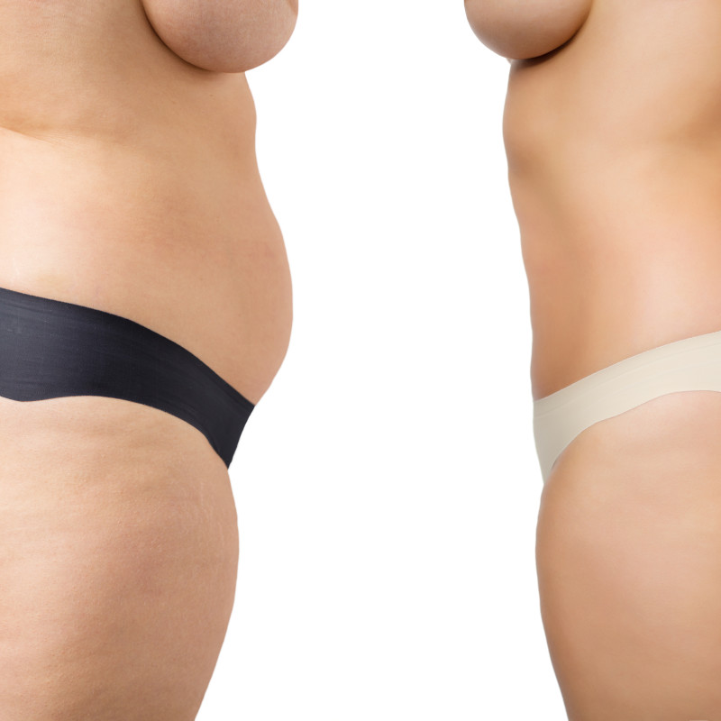 Abdominoplasty