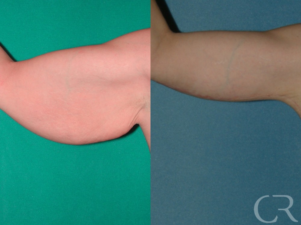 Achieve Toned and Youthful Arms with Arm Lift Surgery (Brachioplasty)