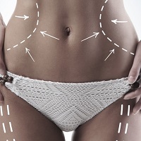 Liposuction