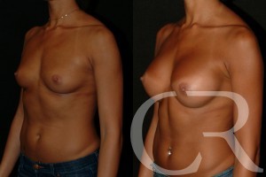 Breast Augmentation 18