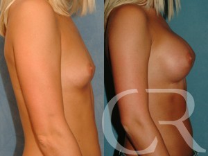 Breast Augmentation 2