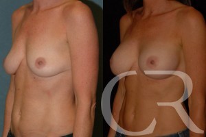 Breast Augmentation 29