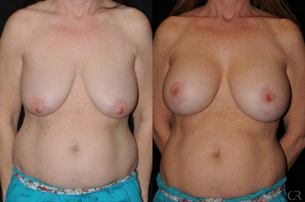 Breast Lift Implant 10
