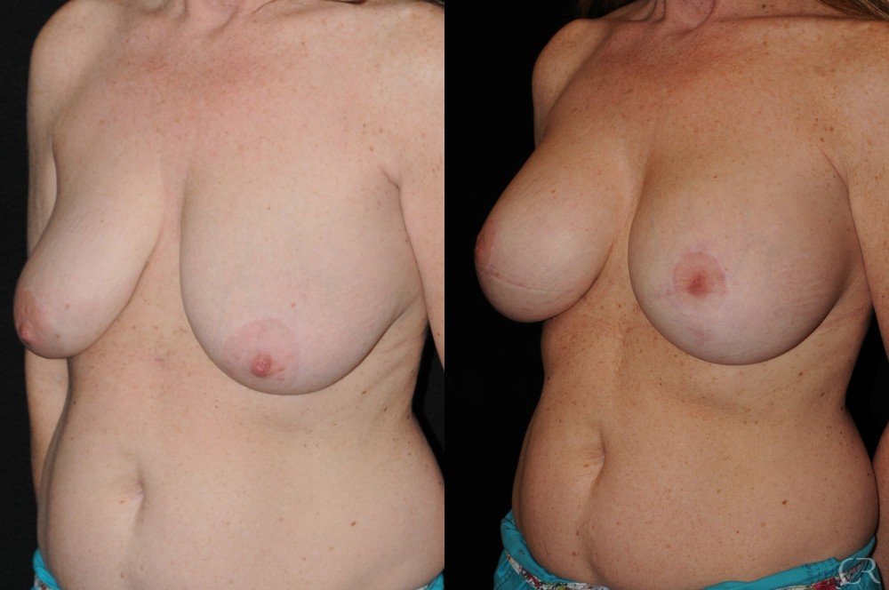 Breast Lift Implant 12