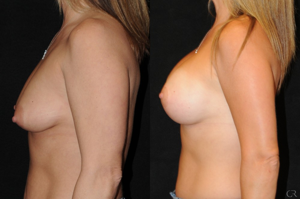 Breast Lift Implant 5