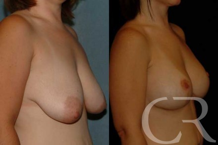 Breast Lift Implant 7