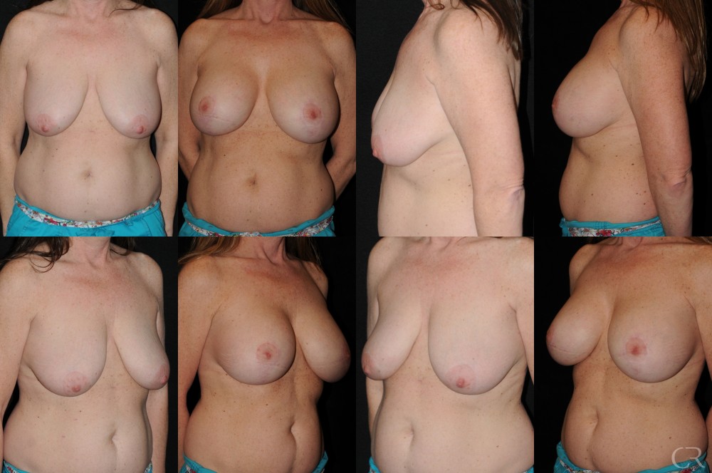 Breast Lift Implant 9