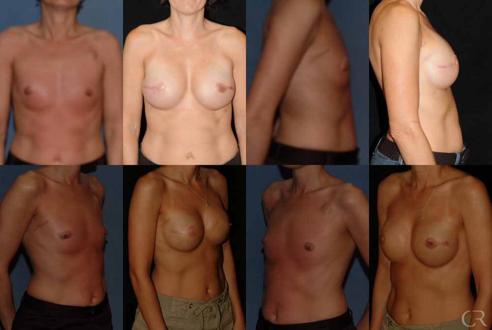 Breast Reconstruction 1