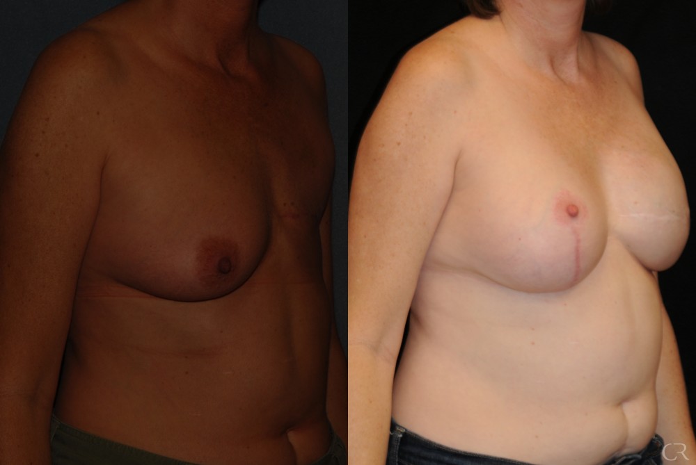 Breast Reconstruction 10