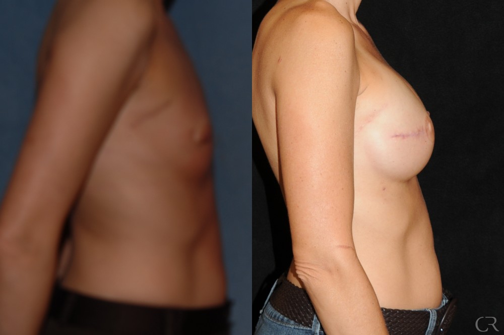 Breast Reconstruction 3