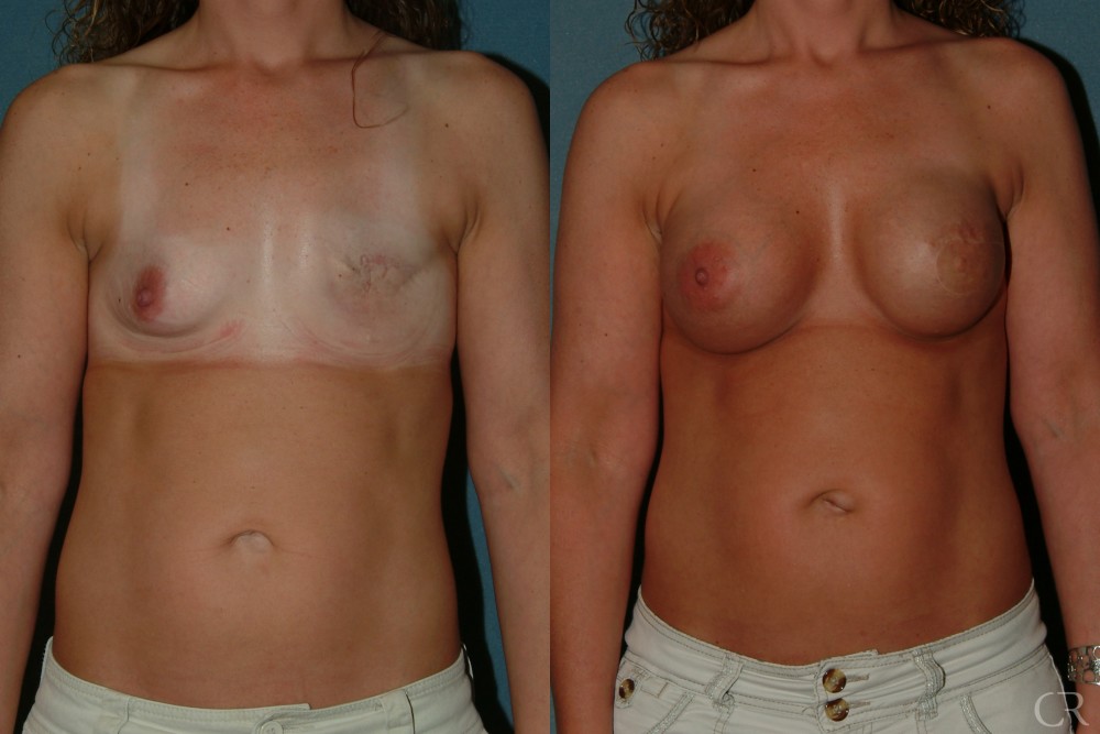 Breast Reconstruction 6