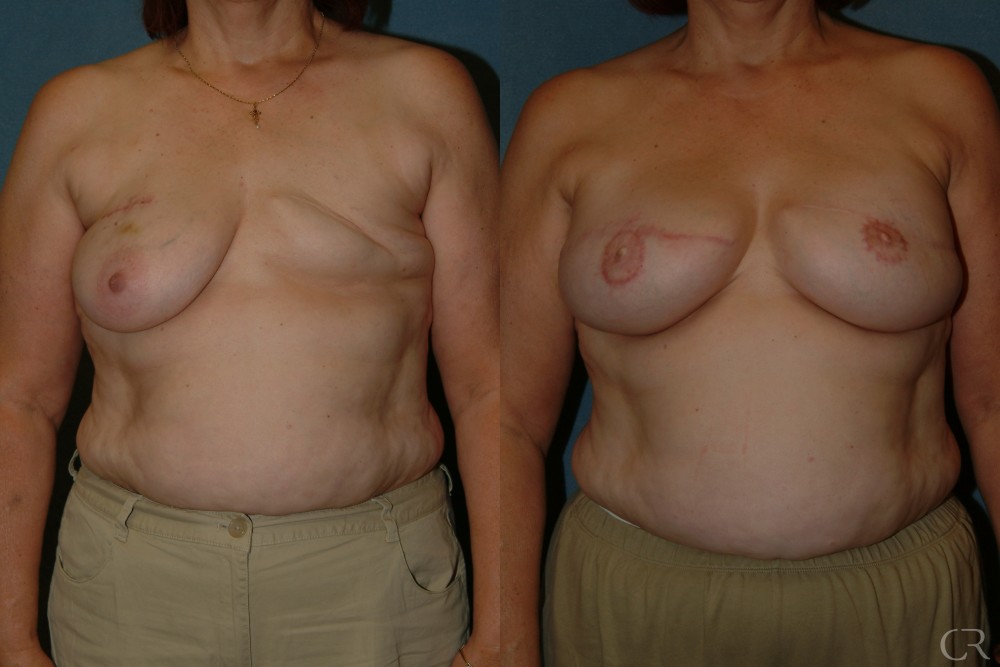 Breast Reconstruction 7