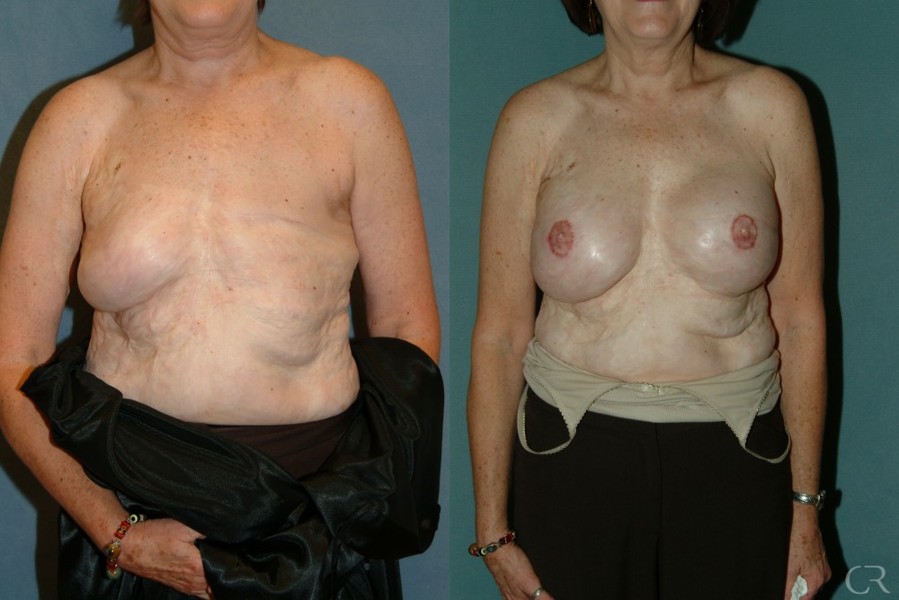 Breast Reconstruction 8