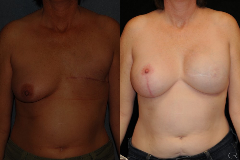 Breast Reconstruction 9