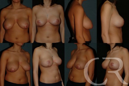 Breast Reduction 1