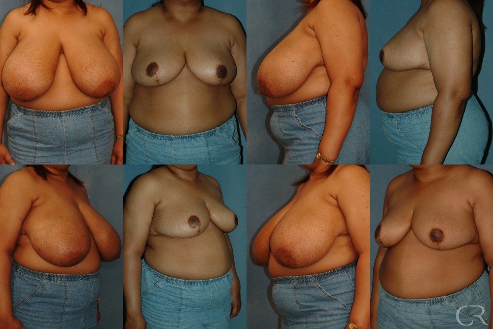 Breast Reduction 11