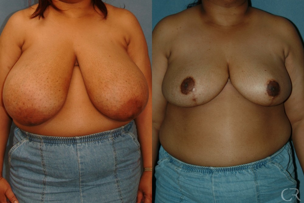 Breast Reduction 12