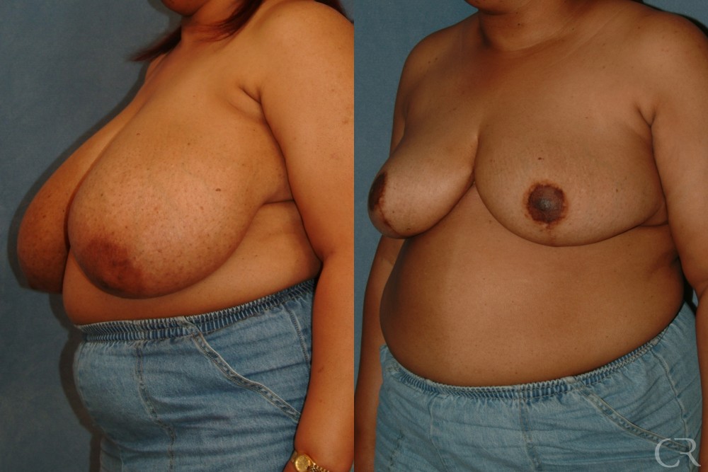 Breast Reduction 13