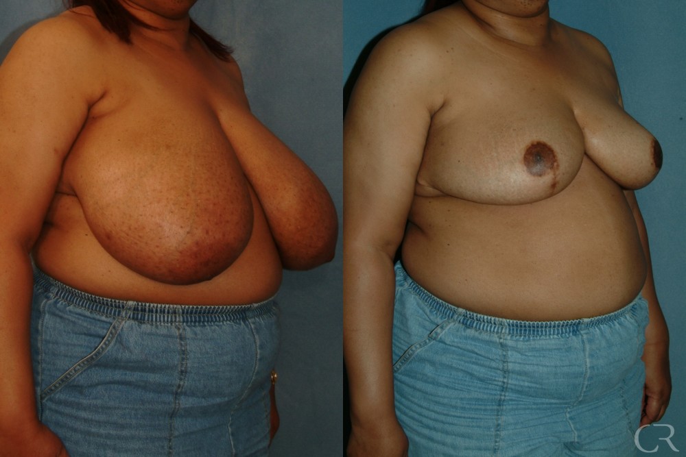 Breast Reduction 14