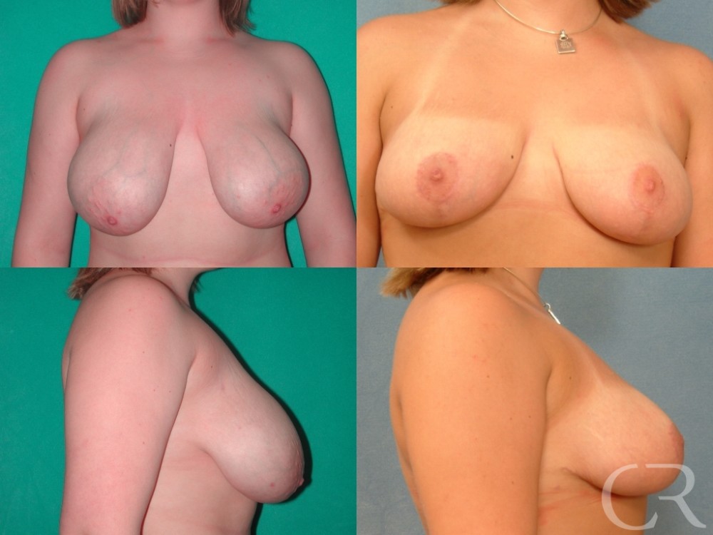 Breast Reduction 16