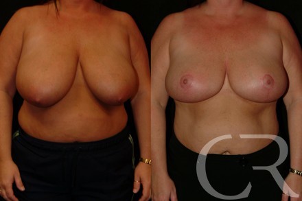 Breast Reduction 8