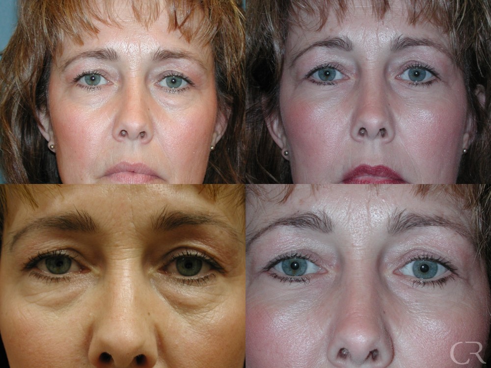 Blepharoplasty risks shop