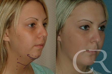 Chin Implants - East Alabama Plastic Surgery - Auburn Med Spa