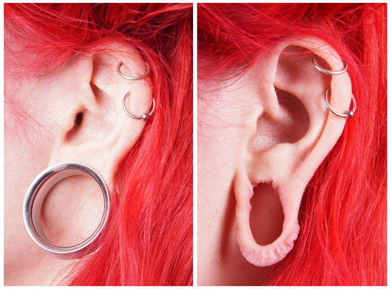 Ear Reconstruction