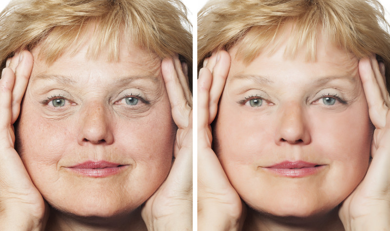 Facelift and Necklift