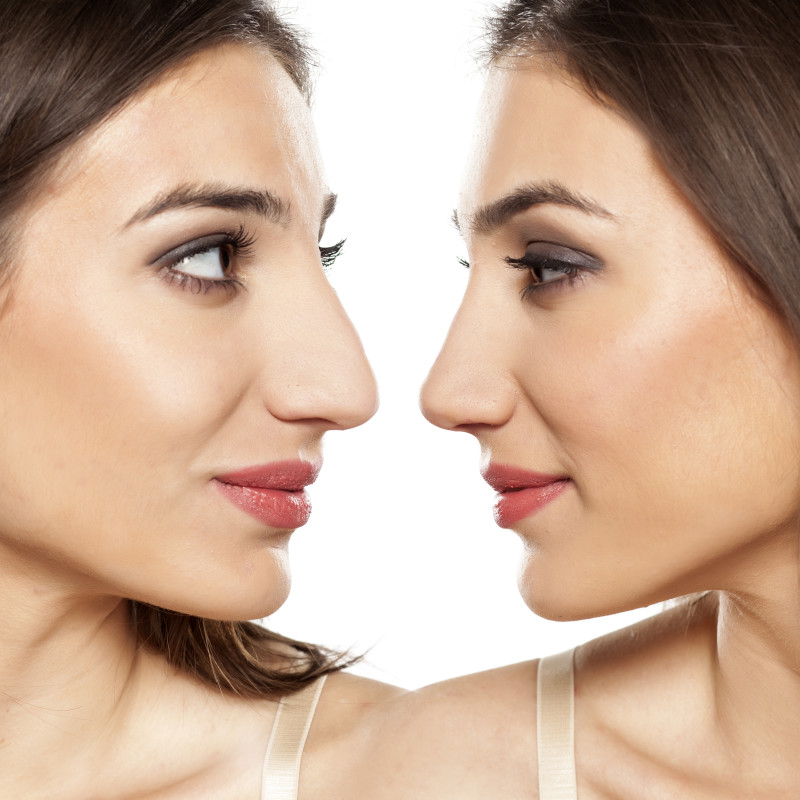 Rhinoplasty