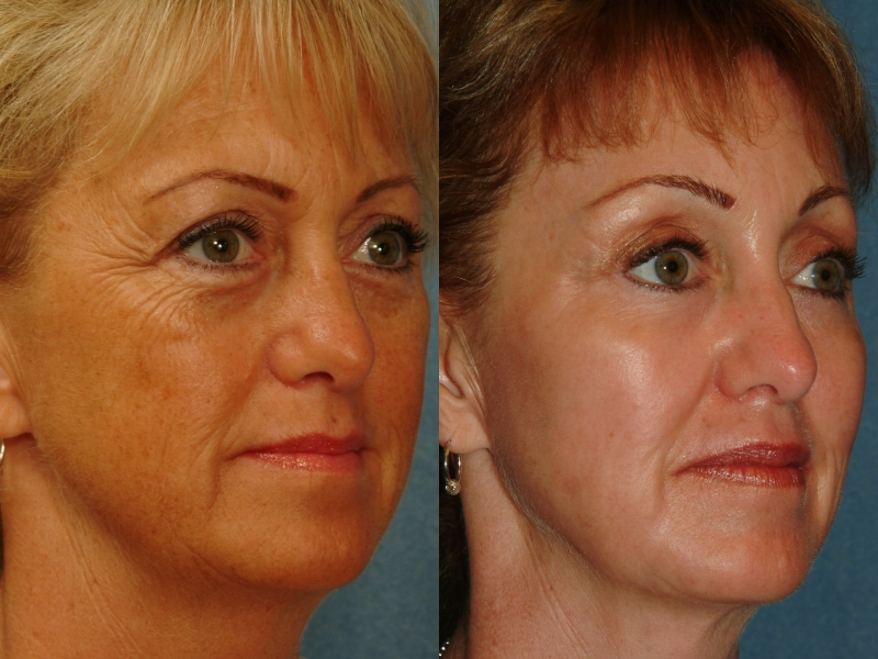Skin Resurfacing / Laser 2