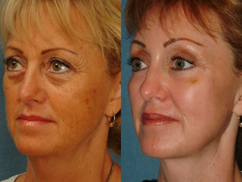 Skin Resurfacing / Laser 3