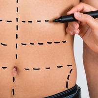 Abdominoplasty