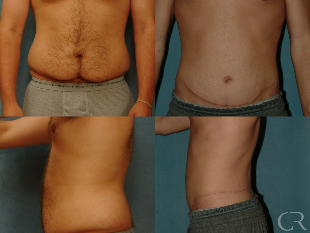 Abdominoplasty for Men