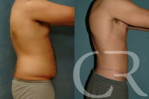 Abdominoplasty for Men