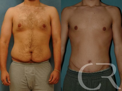 Abdominoplasty for Men