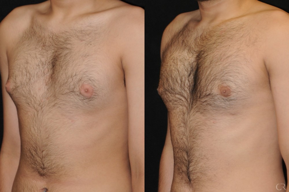 Post Op Surgery Gynecomastia Lipo Slim