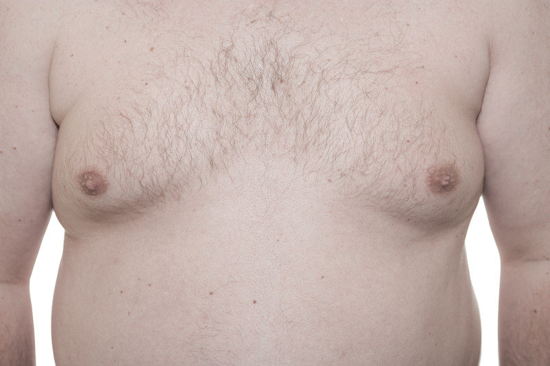 Chest Gynecomastia