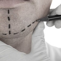 Chin Augmentation