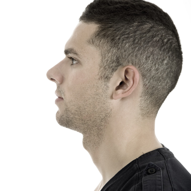 Chin Augmentation