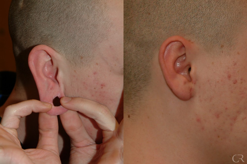 Ear Reconstruction 1