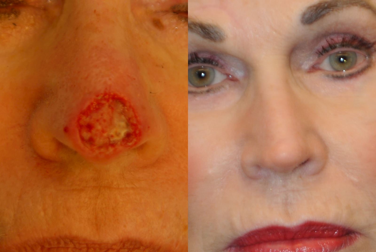 basal cell carcinoma nose scar