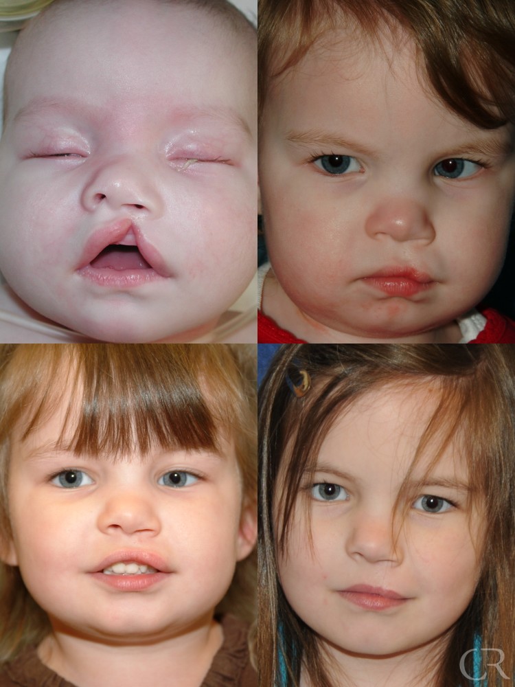 Cleft Lip & Palate - Kentucky Center For Cosmetic & Reconstructive Surgery