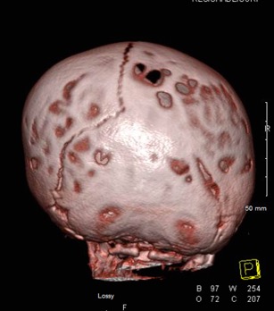 Craniosynostosis CT Scan