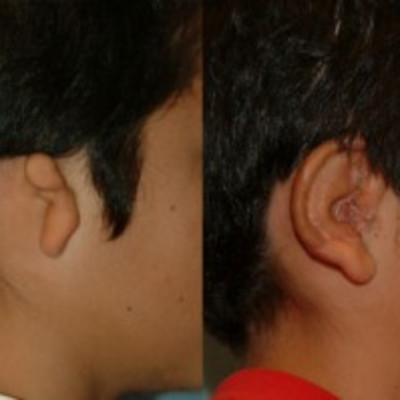 Ear Reconstruction 12