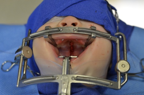 Minimal Invasive Craniofacial Surgery