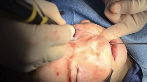 Minimal Invasive Craniofacial Surgery