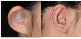 Earlobe Repair Cresskill NJ, Knickerbocker Oral and Facial Surgery