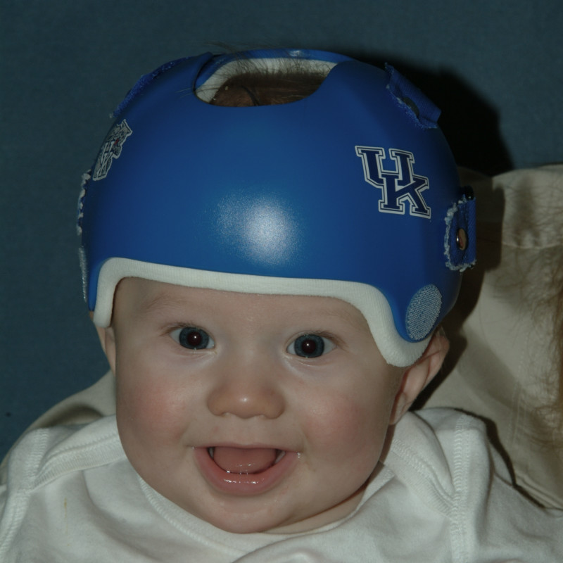 Plagiocephaly