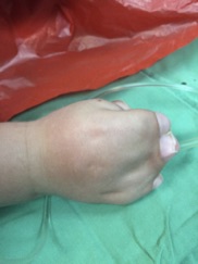 Apert Hand Deformity